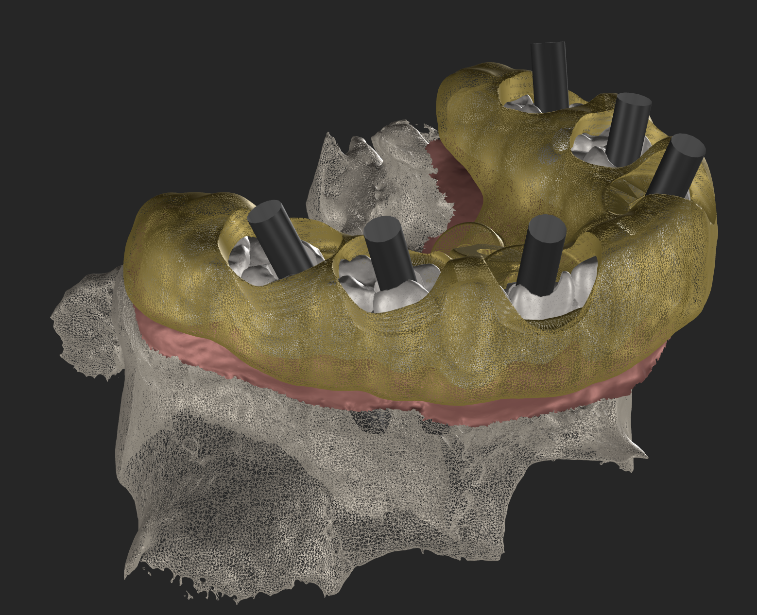 Tecnología CBCT y escáner intraoral para cirugía de implantes en Castellón